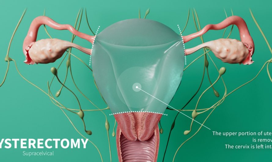 Hysterectomy — A Comprehensive Insight into Dr. Amit Tandon’s Practice at Dr. Kamlesh Tandon Hospital, Agra