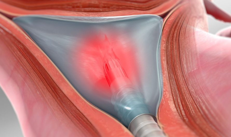 Endometrial Ablation for Heavy Menstrual Bleeding: A Clinical Insight into Dr. Amit Tandon’s Practice at Dr. Kamlesh Tandon Hospital, Agra