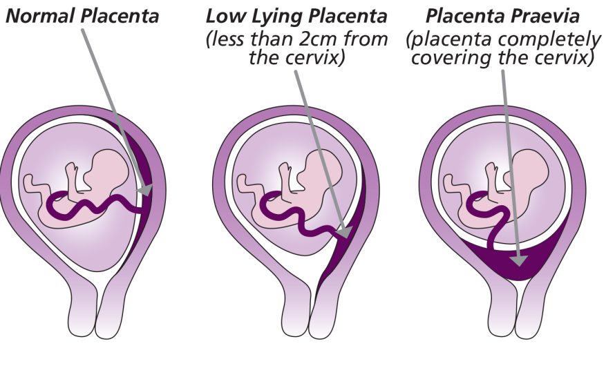 Understanding Lower Placenta and Placenta Previa: Why Prompt Consultation with Dr. Amit Tandon Is Essential