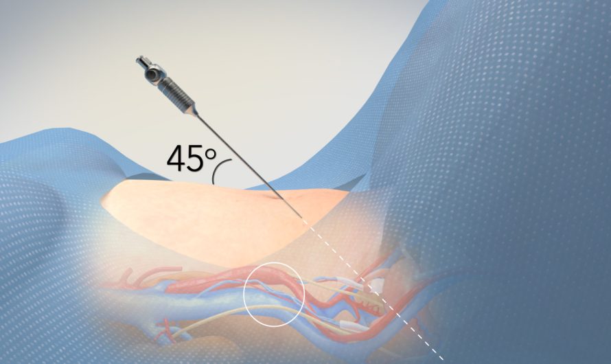 Safe Abdominal Entry Techniques in Laparoscopic Gynaecology Surgery: Expert Insights from Dr. Amit Tandon