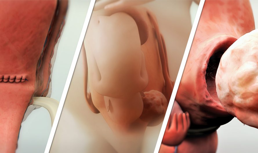 Cesarean Section with Concurrent Myomectomy: A Safe and Effective Approach by Dr. Amit Tandon