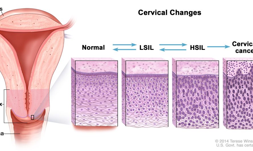 Screening and Management of Cervical Dysplasia: Expert Care with Dr. Amit Tandon