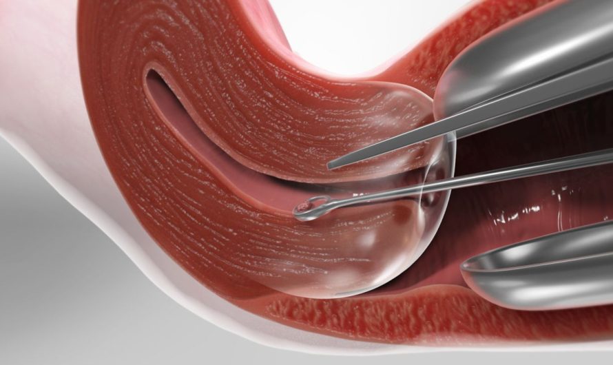 Dilation and Curettage (D&C) in Gynecology: Expert Insights from Dr. Amit Tandon